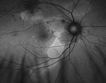 Central Serous Chorioretinopathy
