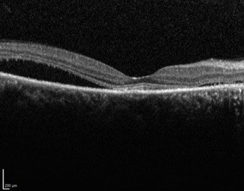 Central Serous Chorioretinopathy