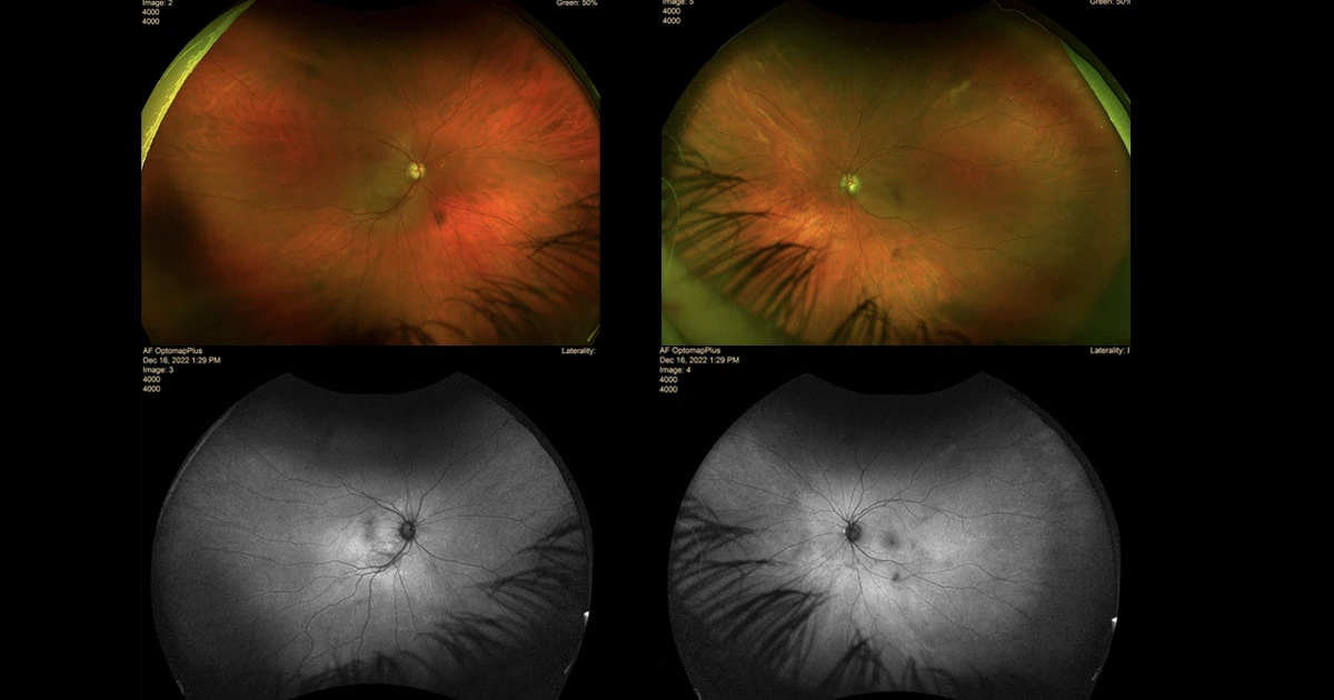 A 64-year-old woman presents with slightly reduced vision in the right eye. She described “feeling sick” for the last 4 weeks. No significant ocular or medical history was reported.