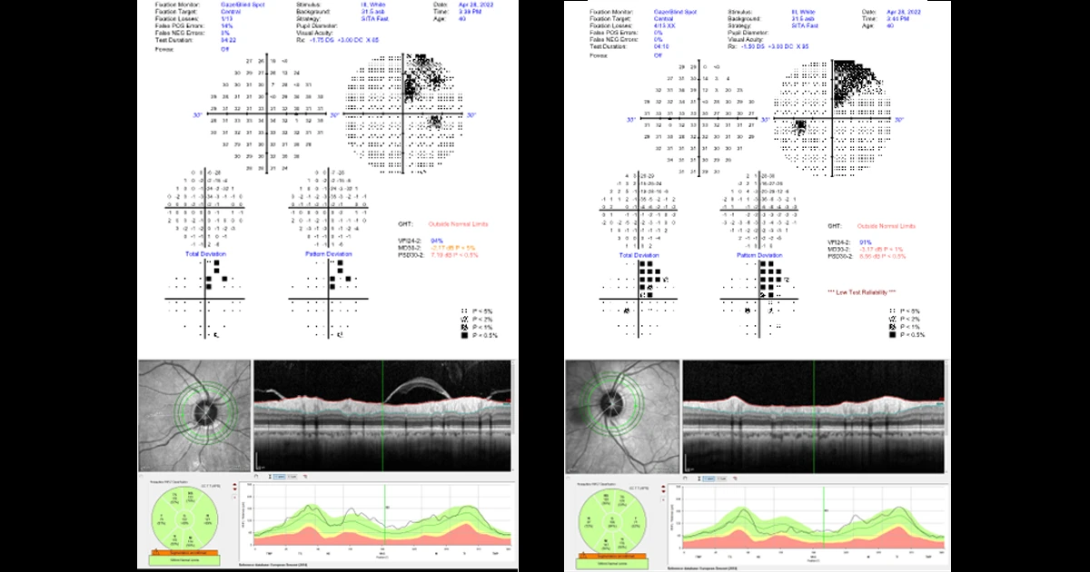 A 44 year old right handed male presented for a routine eye examination. On questioning, he had been experiencing increasing headaches for the past 2 months.