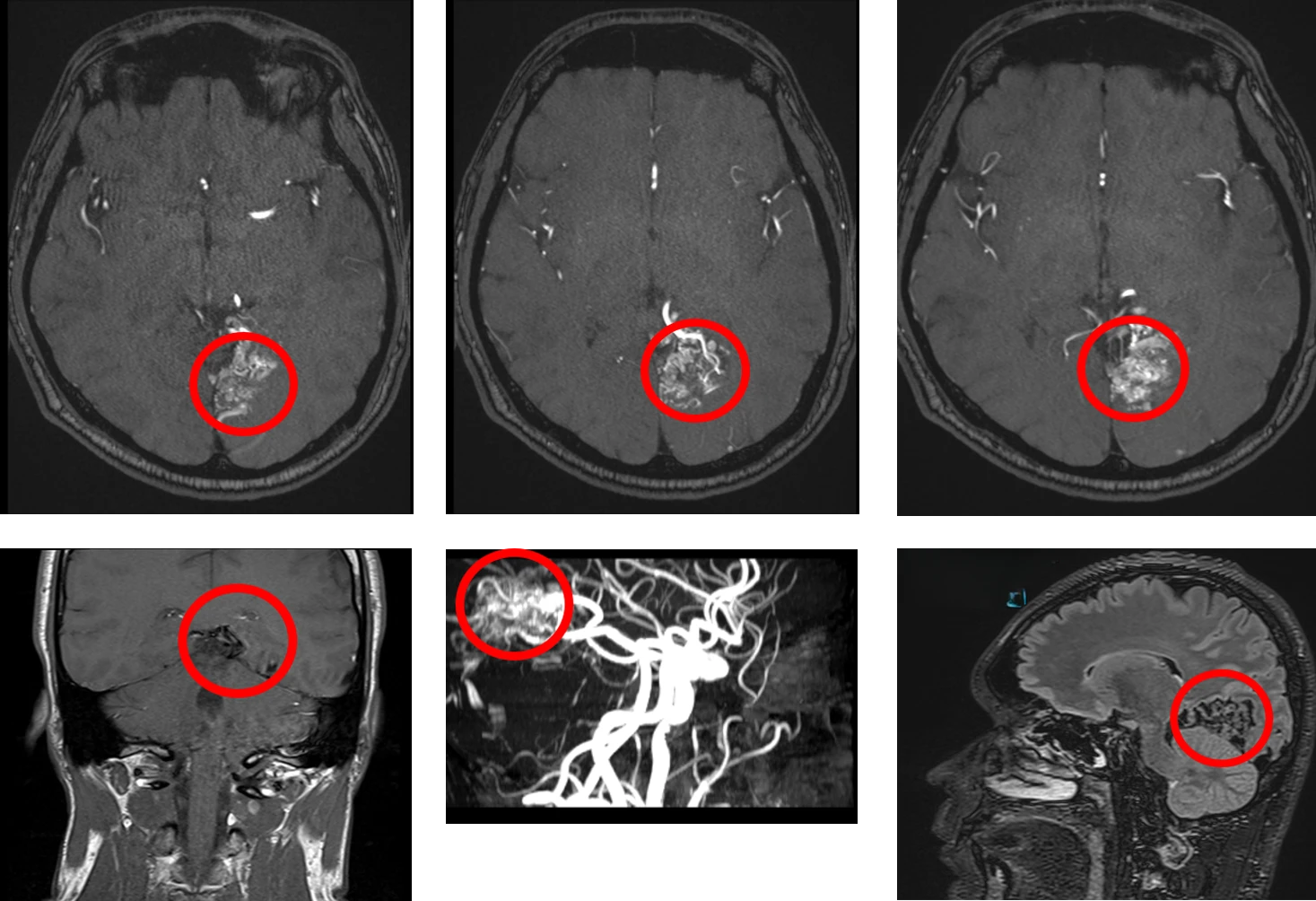 A 44 year old right handed male presented for a routine eye examination. On questioning, he had been experiencing increasing headaches for the past 2 months.