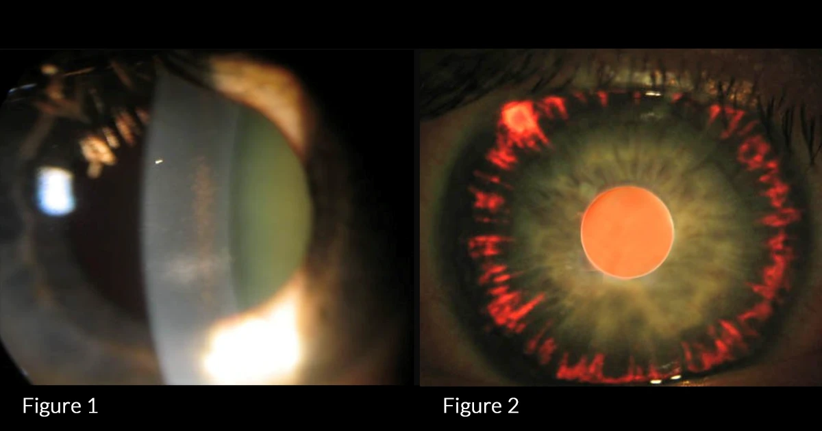 A 47-year-old man presents to you with intermittent blurred vision, which often follows strenuous exercise.