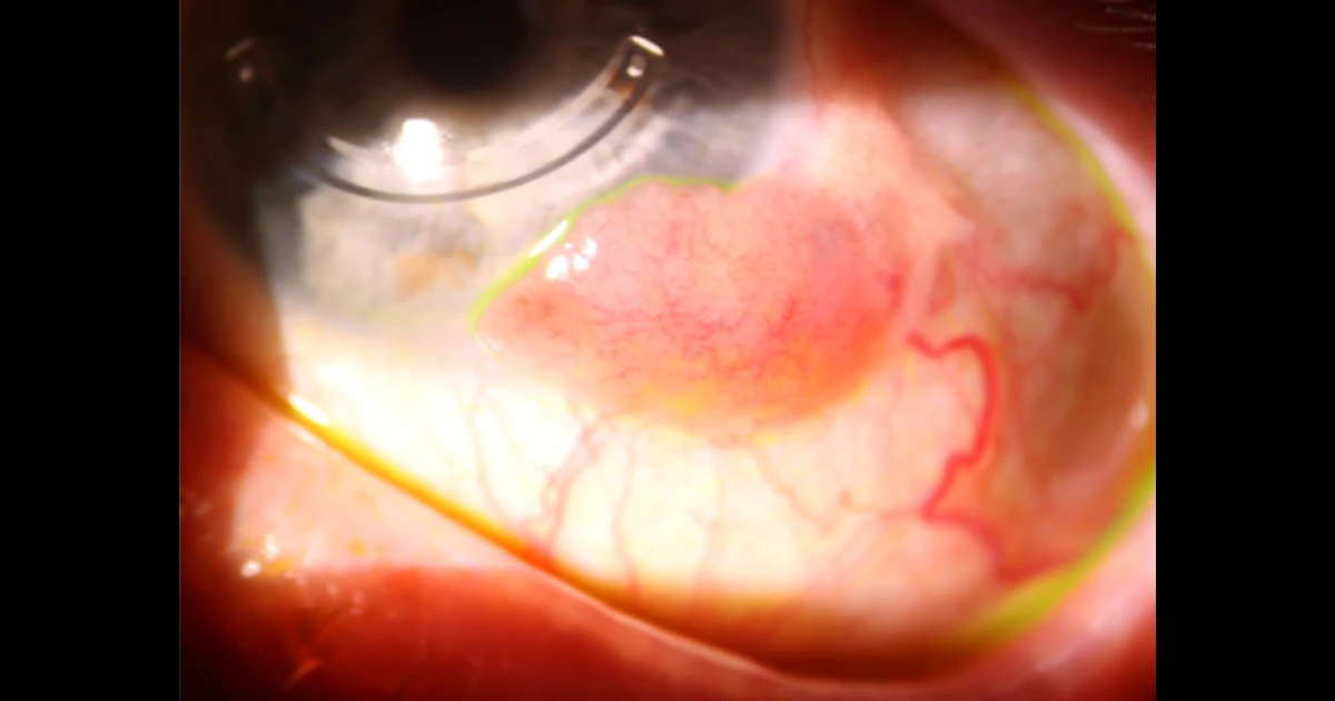 A 62 year old otherwise healthy male presented with a left limbal lesion.  He first noticed the lesion approximately 1 year earlier and noted it gradually increasing in size.  He was troubled by mild redness and irritation.