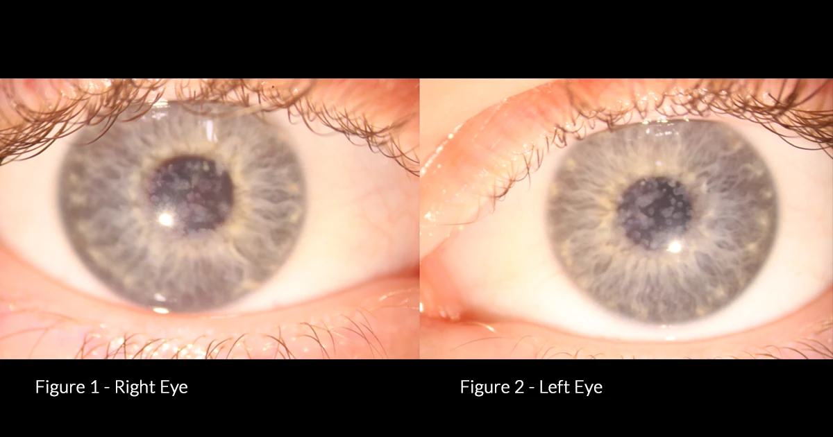 A 13 year old girl presents with reduced vision and recurrent left eye pain on waking. History of viral conjunctivitis some years ago.  No other ocular history. 
