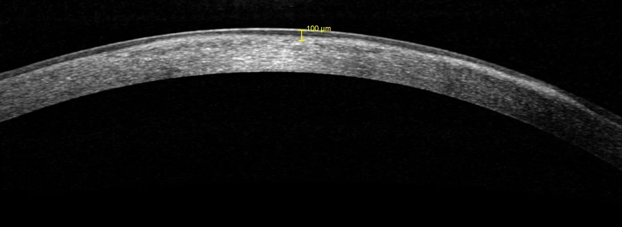 A 13 year old girl presents with reduced vision and recurrent left eye pain on waking. History of viral conjunctivitis some years ago.  No other ocular history.