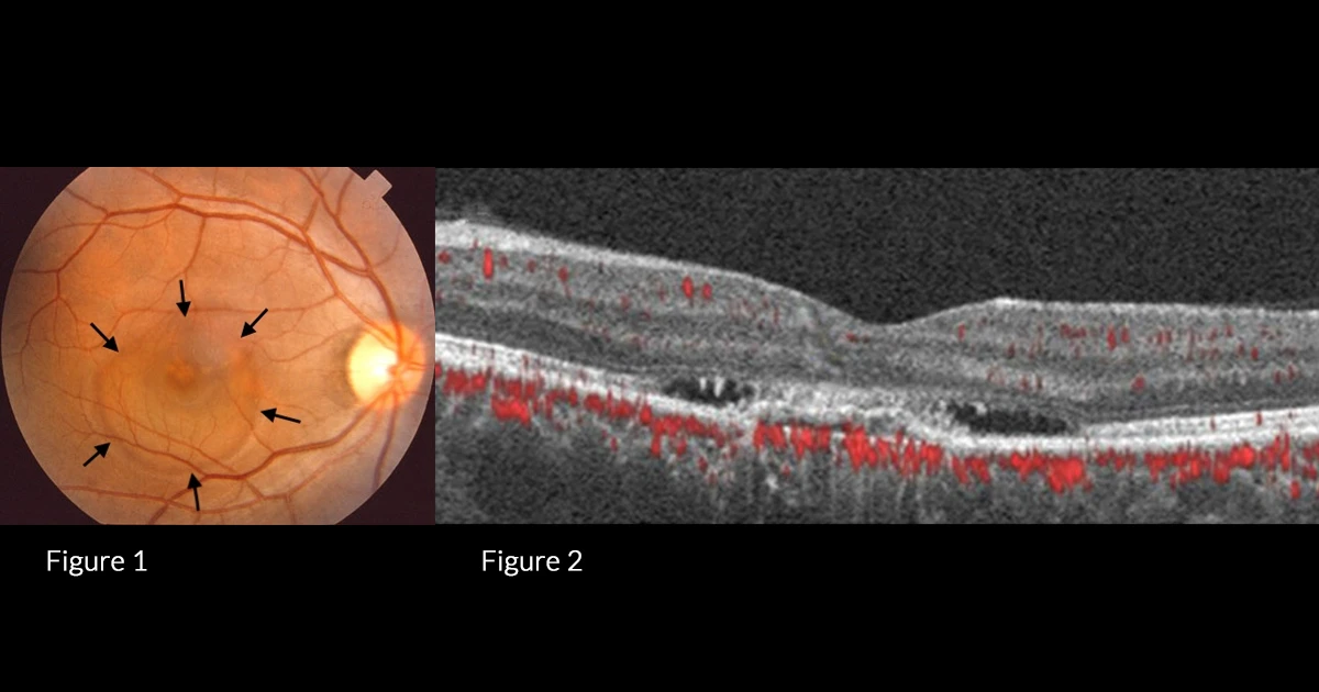 A 62 year old male presented with decreased vision and loss of inferior visual field right eye. 