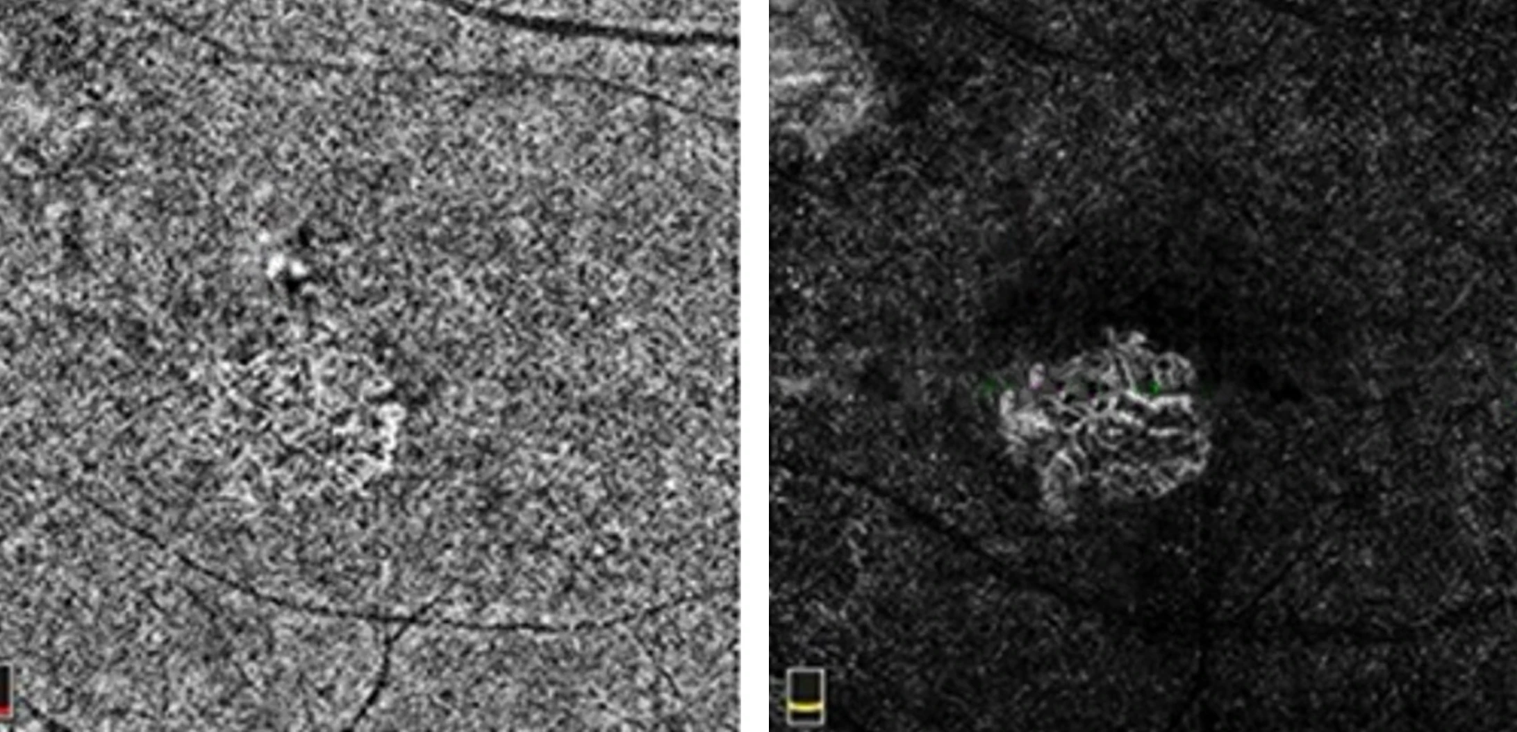 A 62 year old male presented with decreased vision and loss of inferior visual field right eye.
