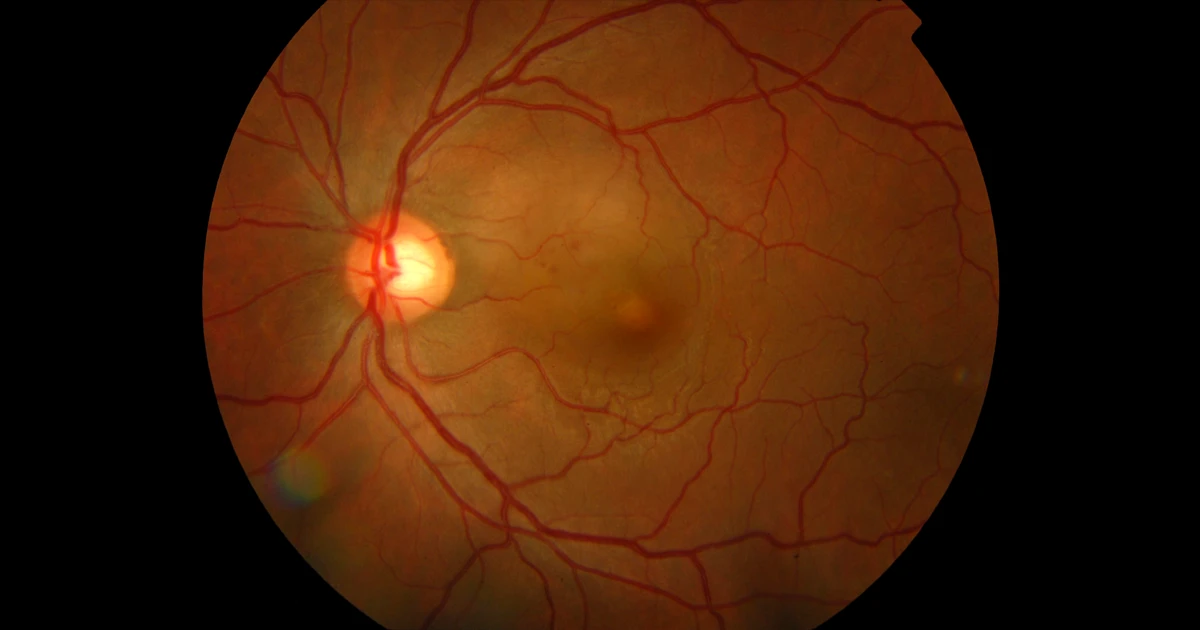 A 31-year-old male presented to our clinic after sudden loss of vision OS. 