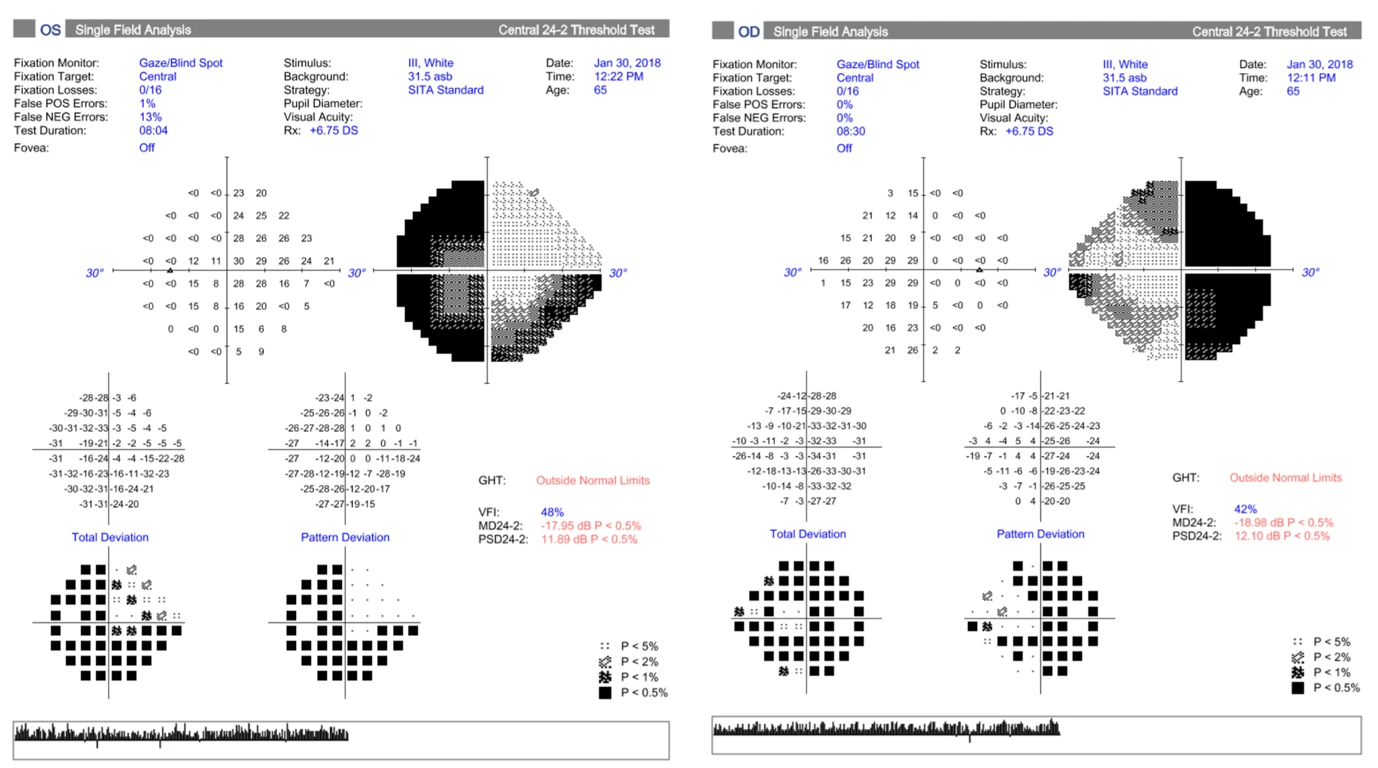 A 62 year old male presented with decreased vision and loss of inferior visual field right eye.