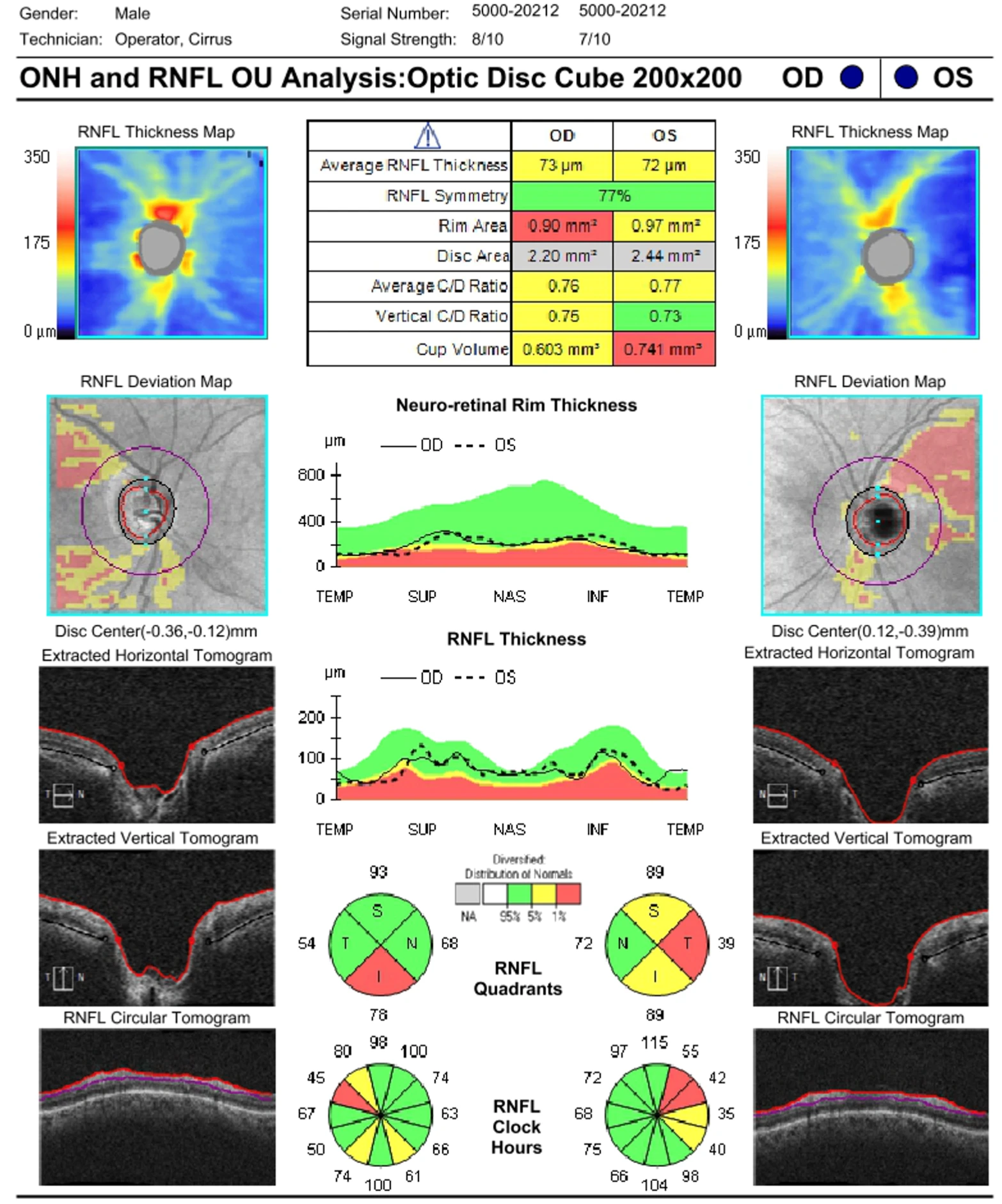 A 62 year old male presented with decreased vision and loss of inferior visual field right eye.