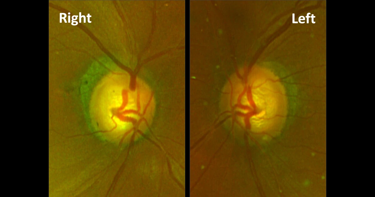 A 65-year-old male, previously been diagnosed with primary open angle glaucoma and was started on latanoprost drops for both eyes. 