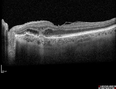 An 84yr old lady was being treated for subretinal new vessel in the right eye. An incidental finding was noticed in the asymptomatic left eye on fundal examination.