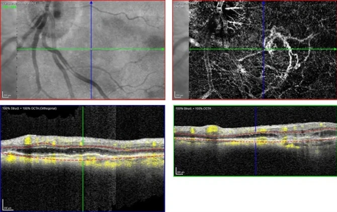 An 84yr old lady was being treated for subretinal new vessel in the right eye. An incidental finding was noticed in the asymptomatic left eye on fundal examination.