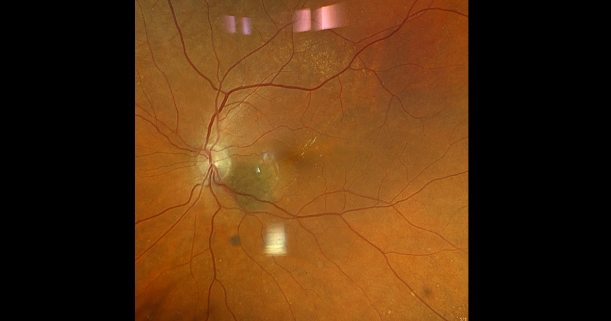 An 84yr old lady was being treated for subretinal new vessel in the right eye. An incidental finding was noticed in the asymptomatic left eye on fundal examination.