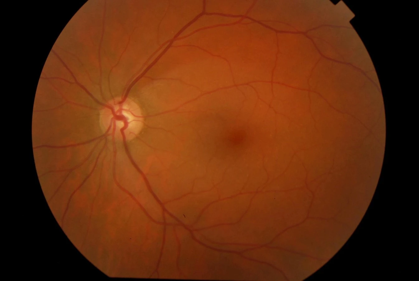 Anterior photo of 65-year-old male with a painless, chronically red left eye