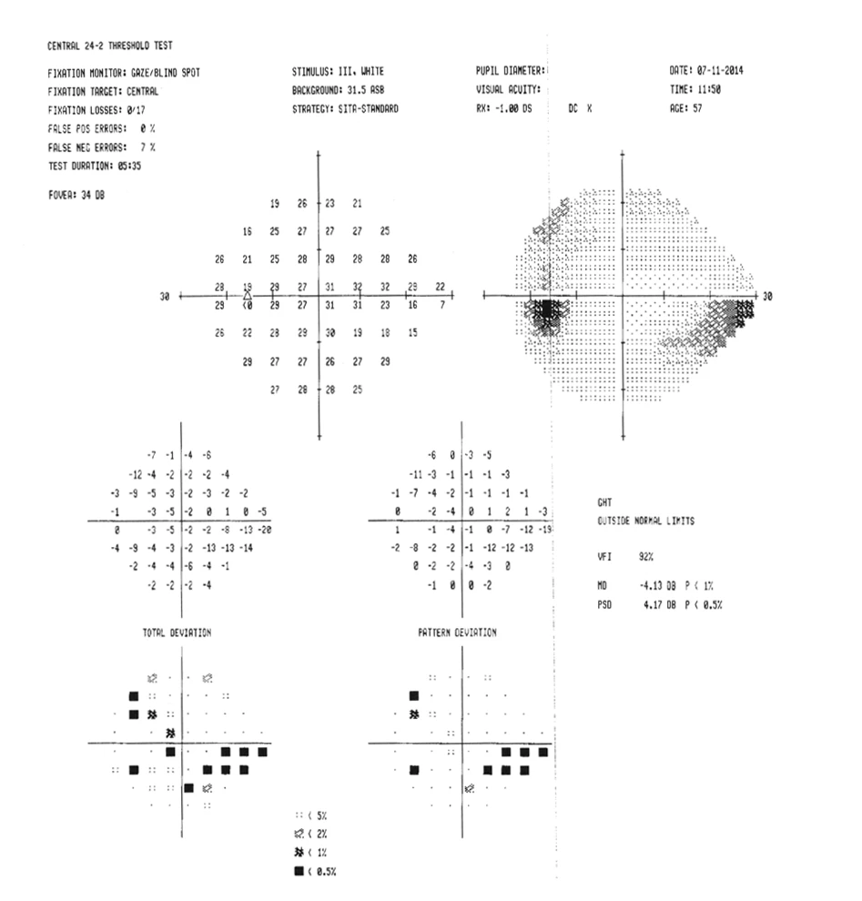 Visual fields of a 65-year-old male with a painless, chronically red left eye