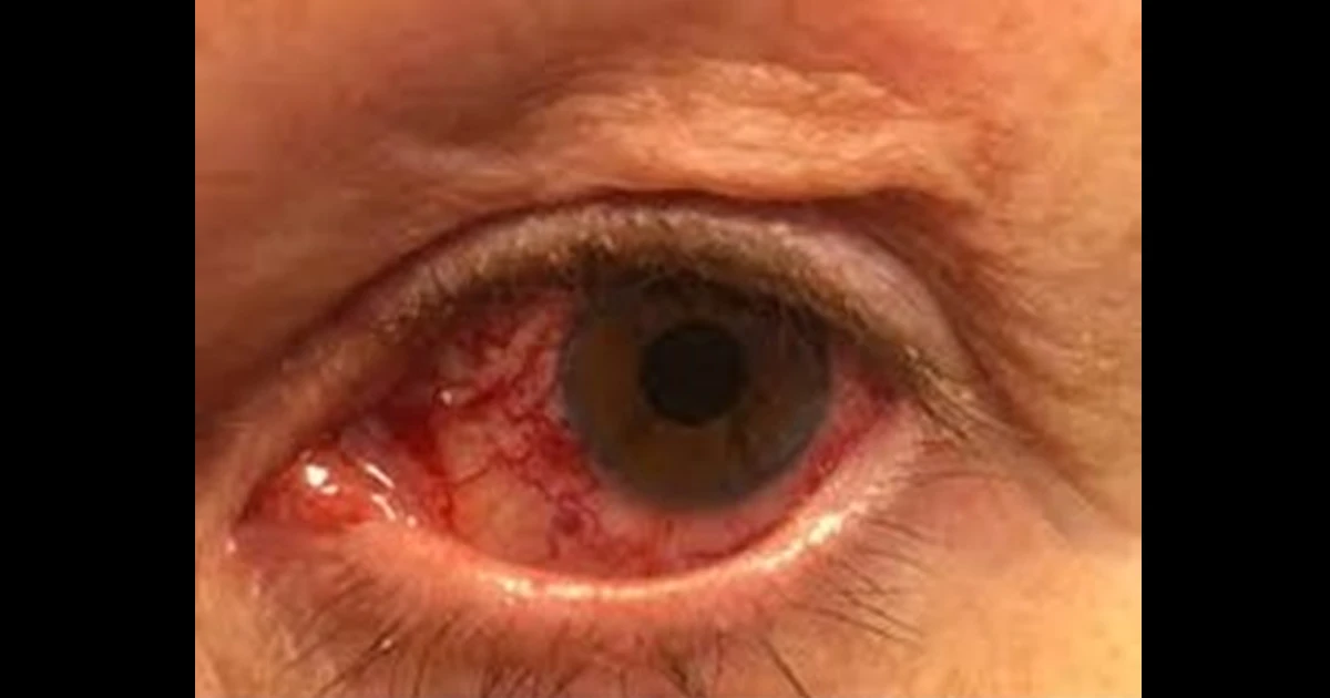 A 65-year-old male presents to your office with a painless, chronically red left eye. 