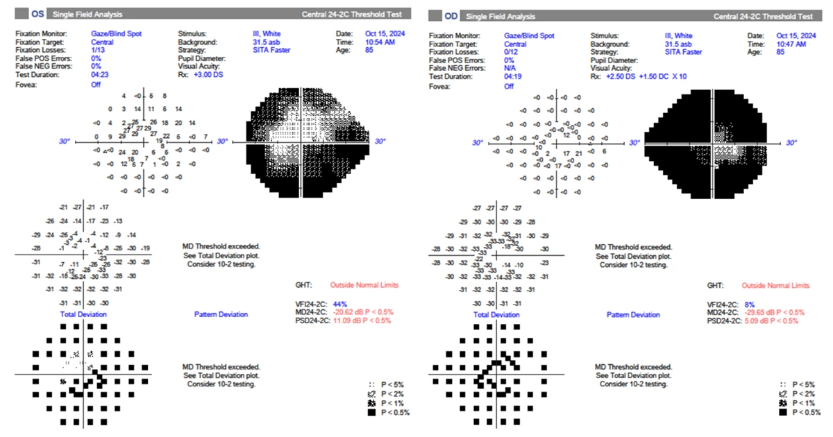 A 36-year-old Thai woman presented to Sydney Eye Hospital with a six-month history of blurred vision. 