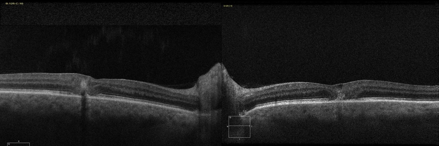 An 84yr old lady was being treated for subretinal new vessel in the right eye. An incidental finding was noticed in the asymptomatic left eye on fundal examination.