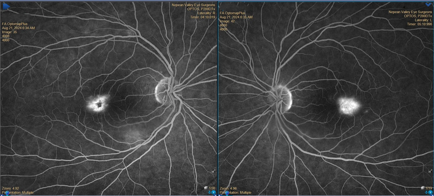 An 84yr old lady was being treated for subretinal new vessel in the right eye. An incidental finding was noticed in the asymptomatic left eye on fundal examination.