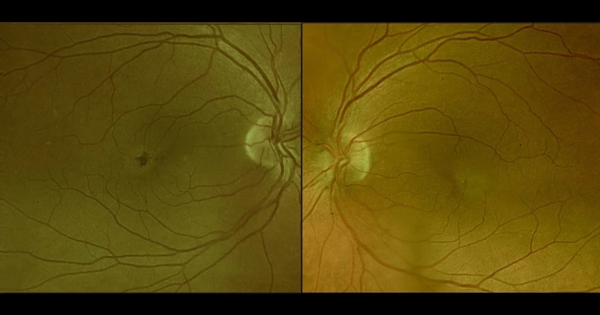 A 60-year-old caucasian male was referred with complaints of a gradual reduction in visual acuity over the last 12 months. 