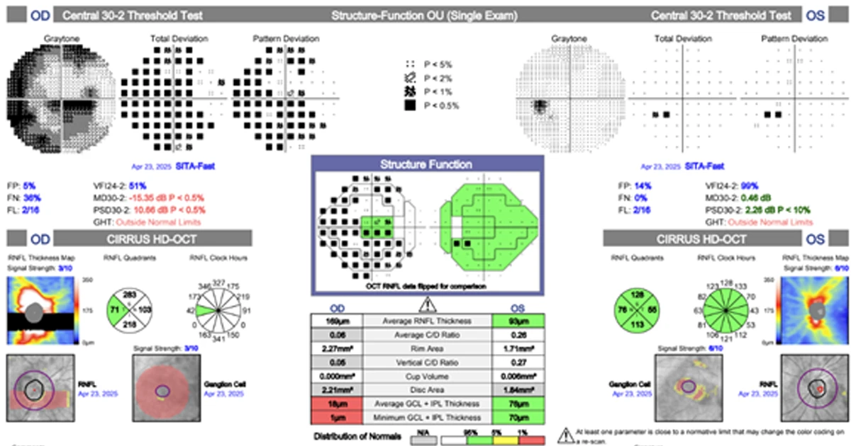 A 60-year-old caucasian male was referred with complaints of a gradual reduction in visual acuity over the last 12 months. 