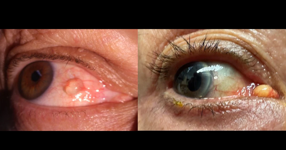 A 45 year old man with a lesion affecting the medial bulbar conjunctiva and a 64 year old man  with a slowly enlarging lesion affecting the right caruncle.