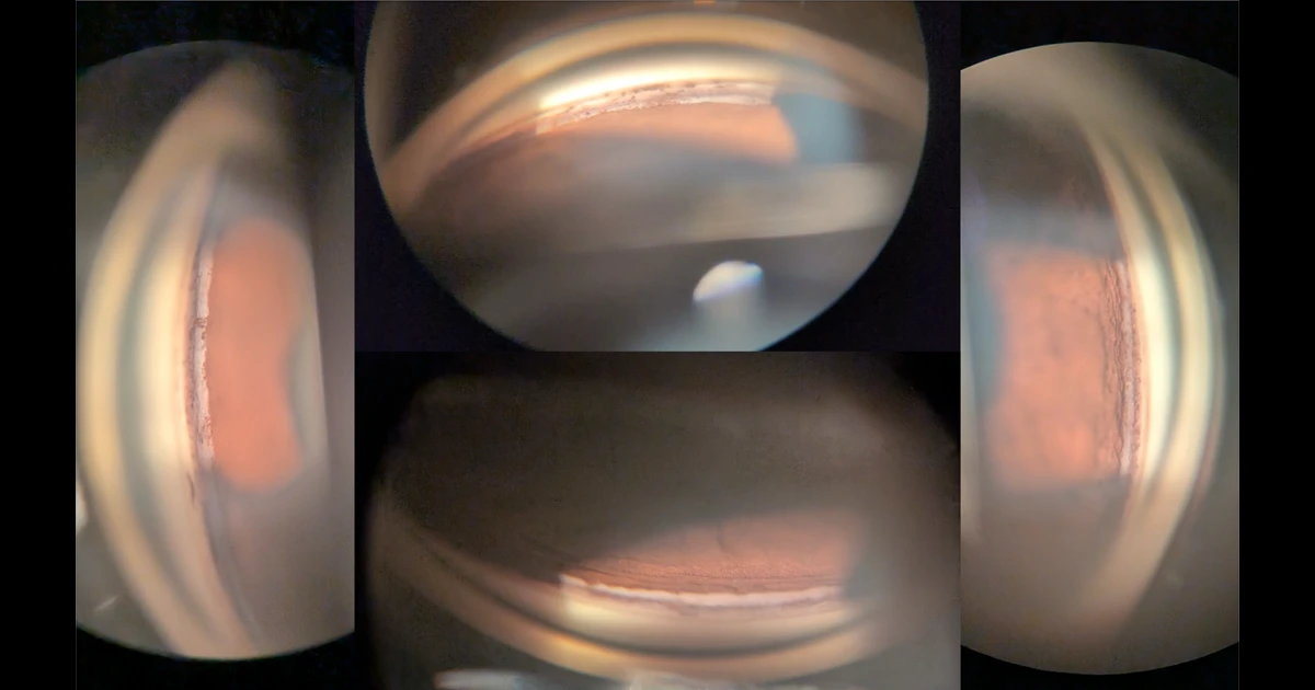 A 38-year-old male has been referred to you for follow up, 6 months after blunt trauma to his left eye. 