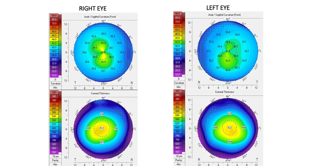 A 30 year old male was referred for a second opinion to discuss his suitability for laser surgery. 
