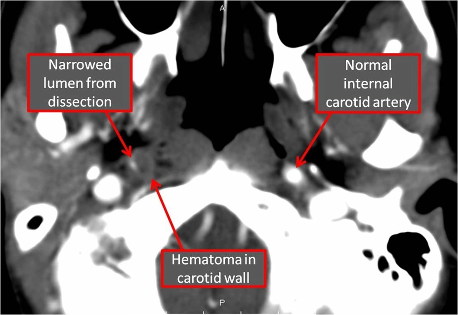CT angiogram showing right sided carotid dissection