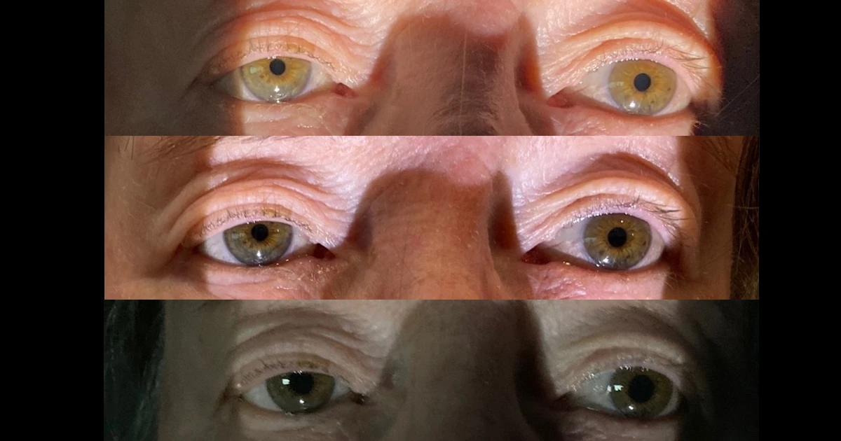 A 30 year old male was referred for a second opinion to discuss his suitability for laser surgery. 