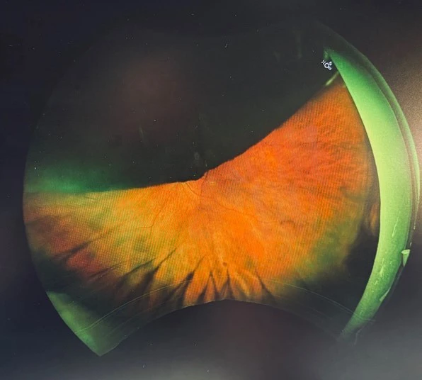 Large superior pigmented choroidal mass 
