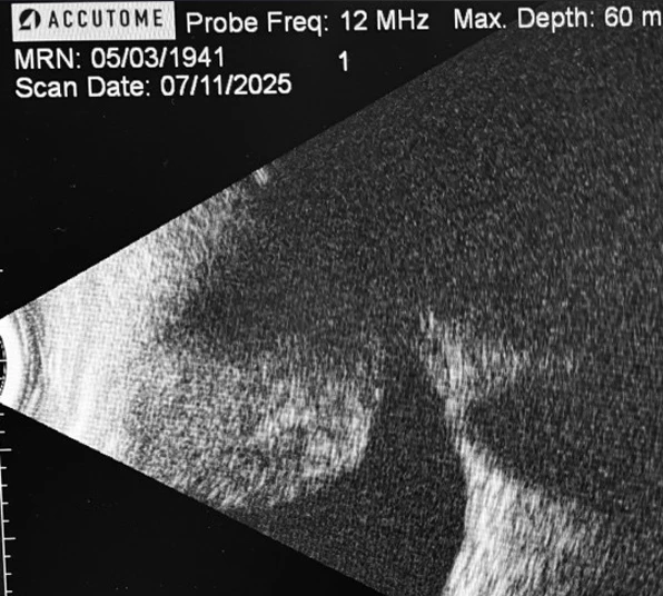 B-Scan ultra sound displaying a large choroidal lesion with low internal reflectivity – consistent with a choroidal melanoma