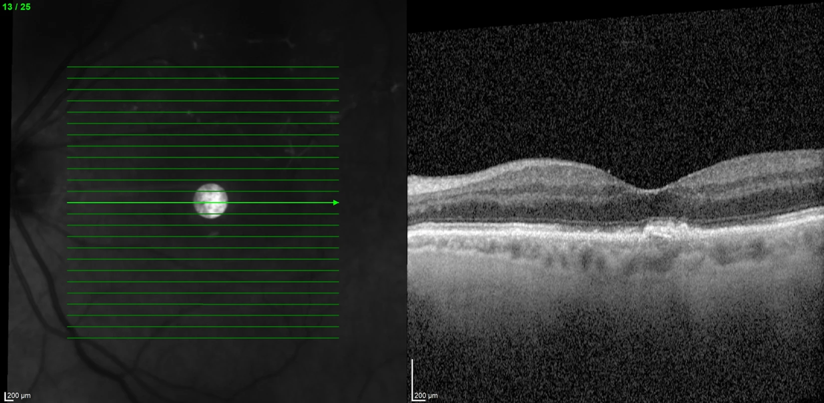 A 25-year-old man presented with one week onset of decreased vision, 6/12 OU and central scotomas in both eyes. 