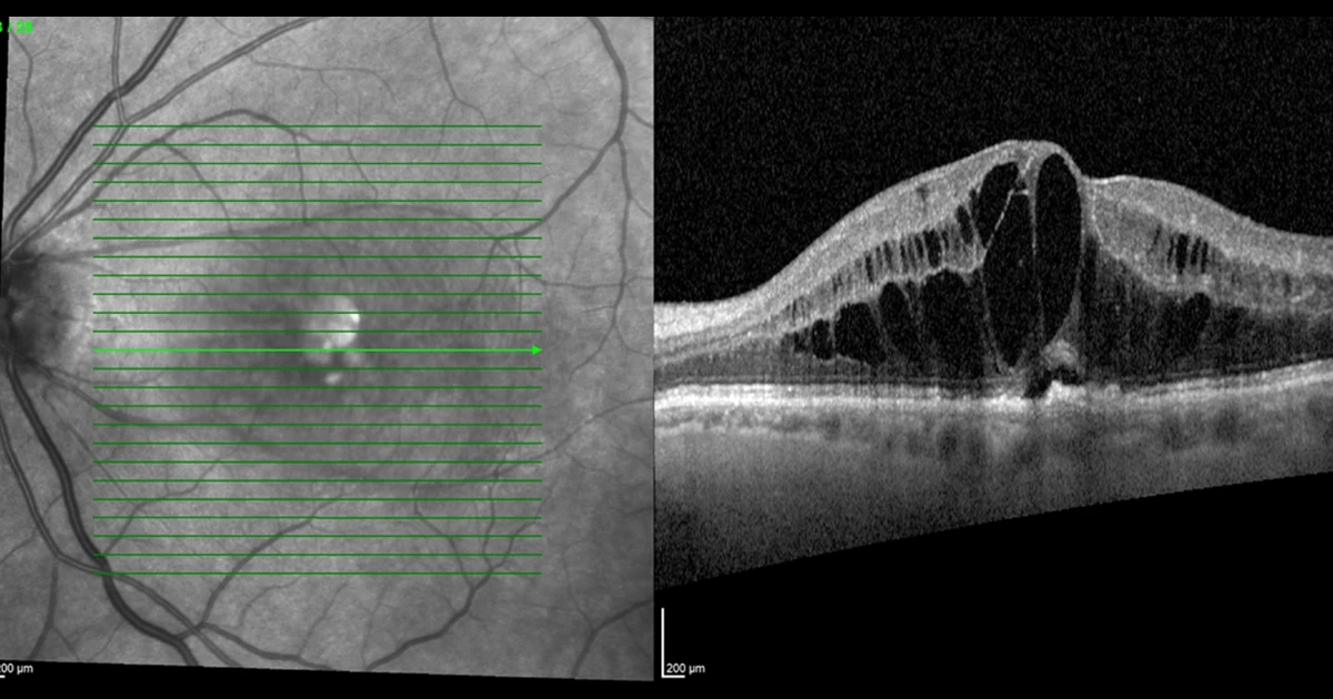 An 89-year-old man with cystoid macular oedema in his left eye received an Ozurdex (dexamethasone) implant. His intraretinal fluid resolved completely.