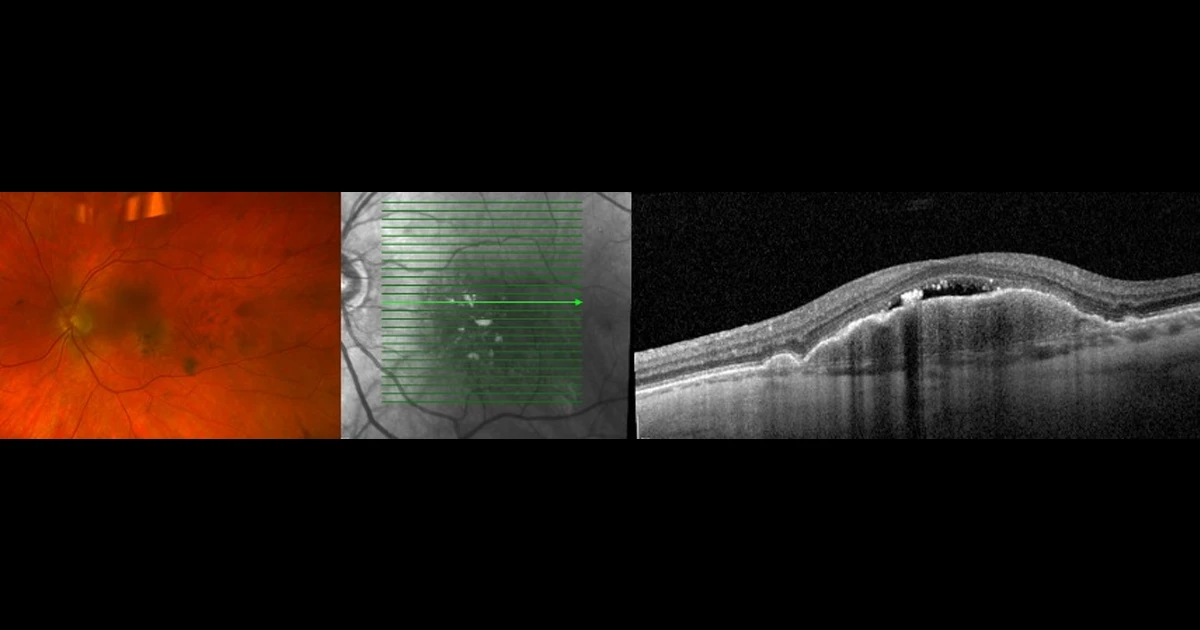 A 25-year-old man presented with one week onset of decreased vision, 6/12 OU and central scotomas in both eyes. 